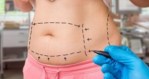 Liposucción: qué debés saber para evitar riesgos