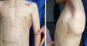 Adolescente de Chubut: El primero en recibir un cardiodesfibrilador subcutáneo en América Latina