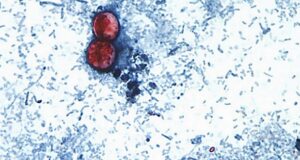 Reportan las primeras dos muertes por brote de ciclosporiasis en Estados Unidos